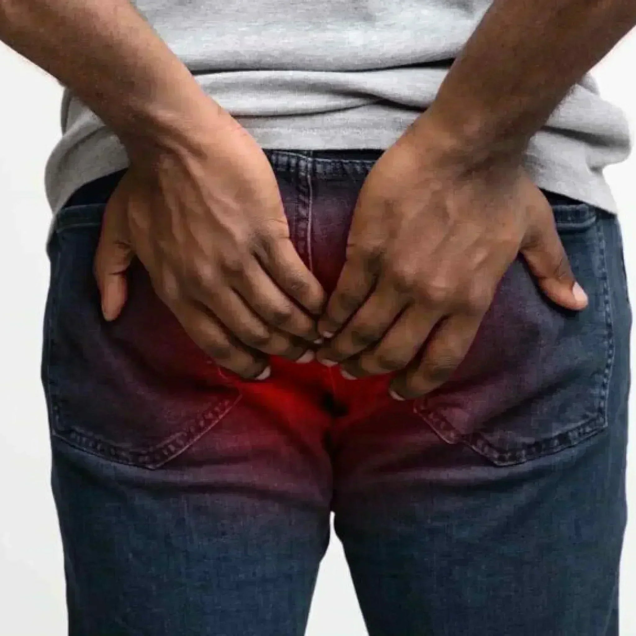 Anal Fissure: Causes, Symptoms and Treatment Options